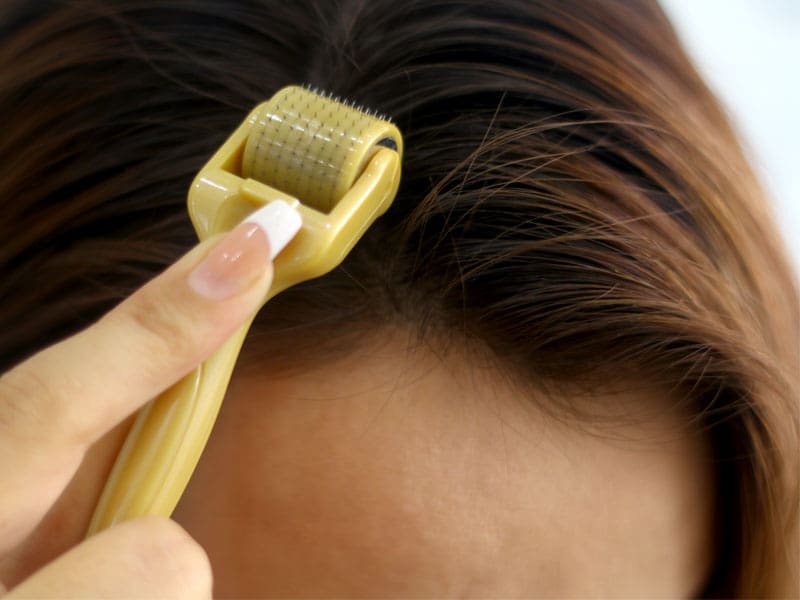 درمان ریزش مو با میکرونیدلینگ