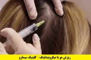 میکرونیدلینگ در درمان ریزش مو