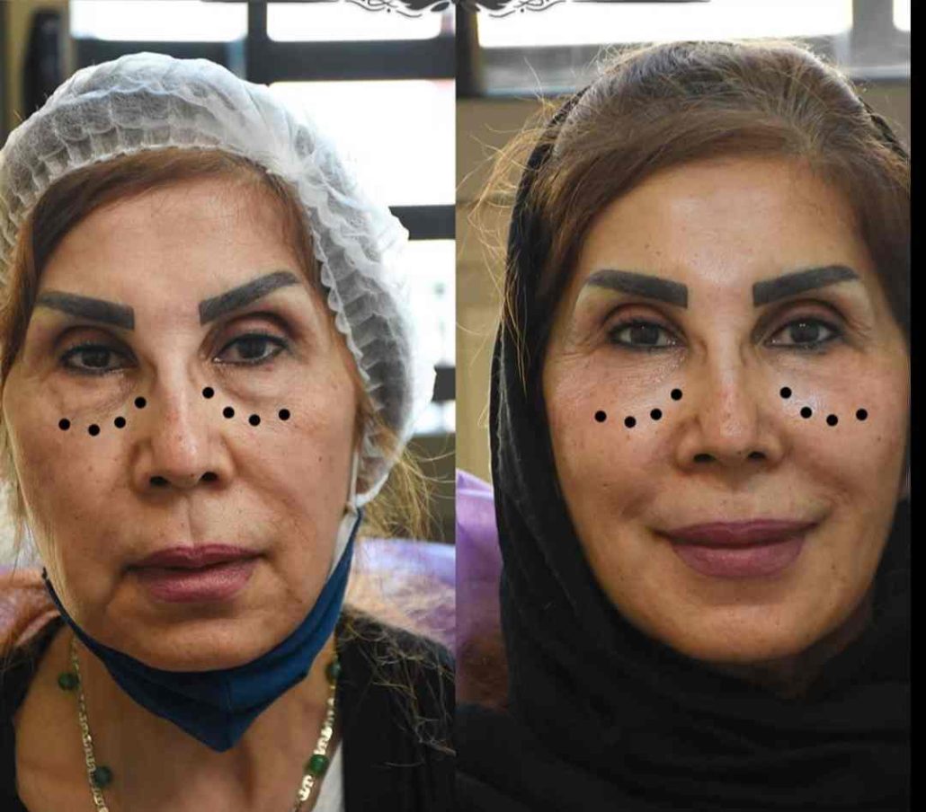 تزریق فیلر زیر چشم