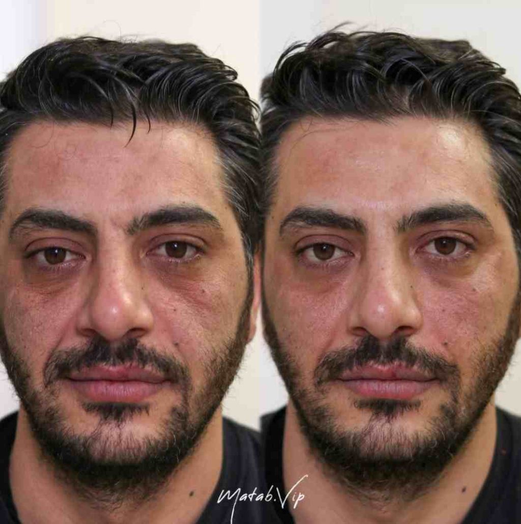 تزریق فیلر زیر چشم در میرداماد