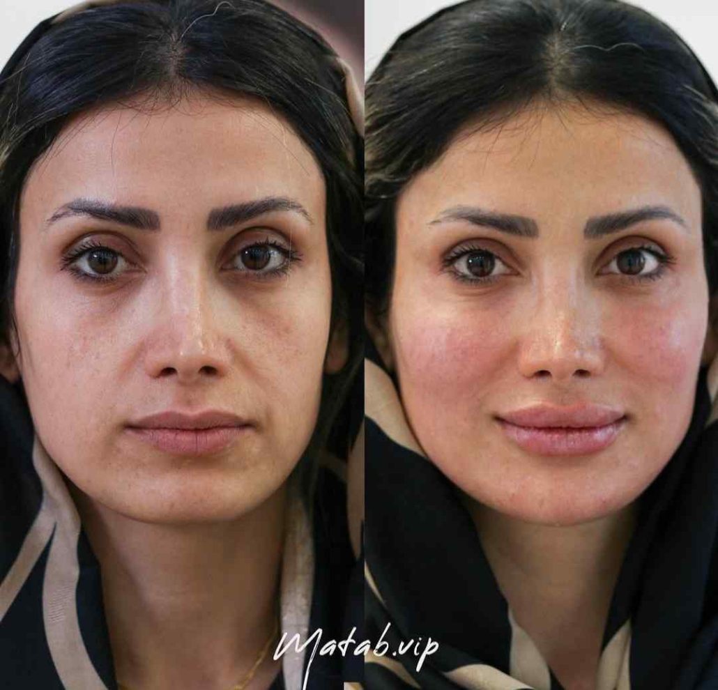 زاویهسازی صورت