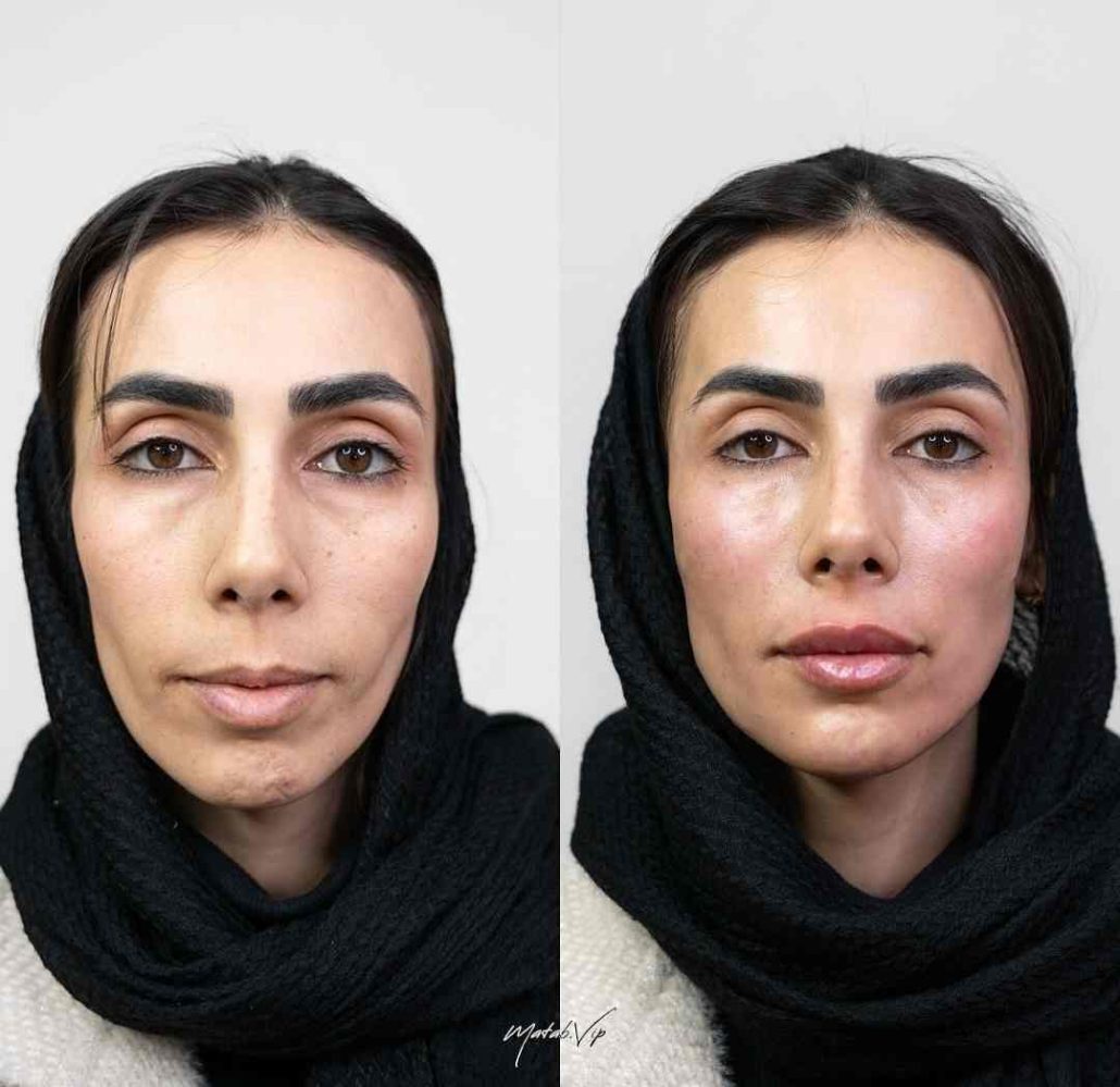 مزایای زاویهسازی صورت