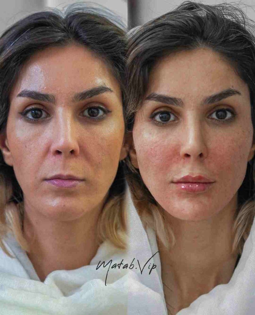 زاویهسازی صورت در مطب VIP سیمارو