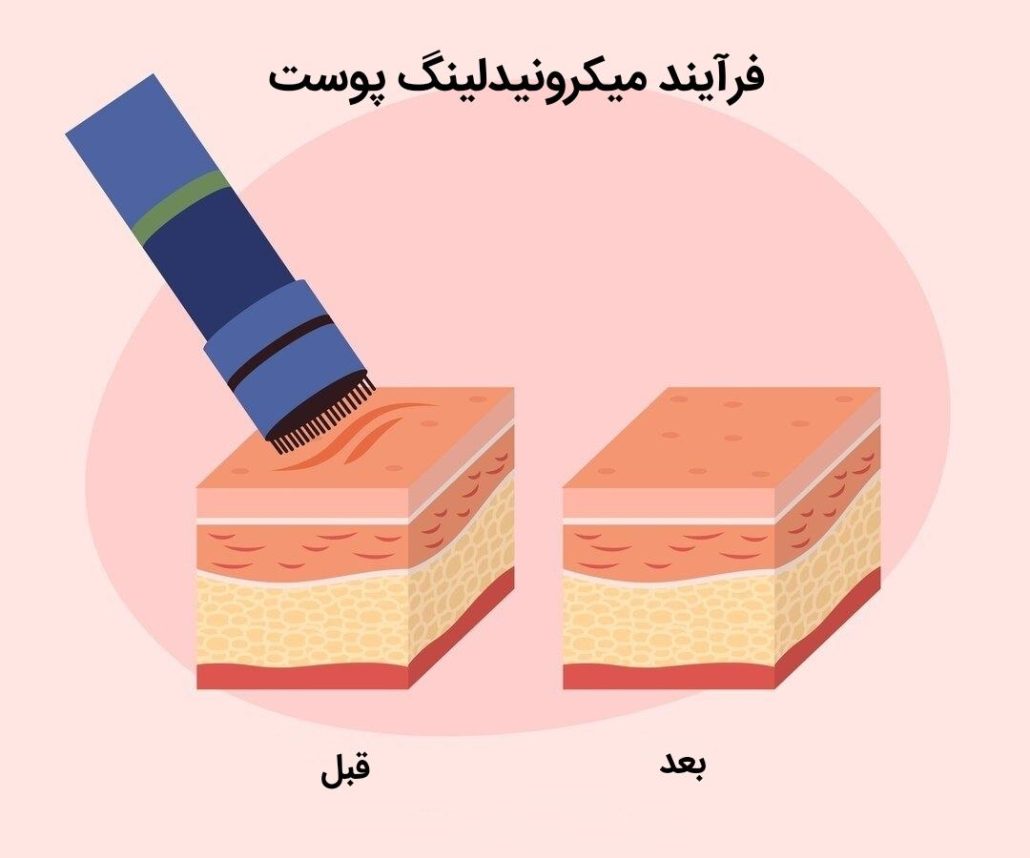 جوانسازی پوست با میکرونیدلینگ